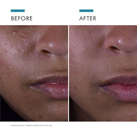 Silymarin CF Serum For Blemish Prone Skin