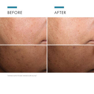 Discoloration Defense For Skin Discoloration